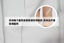 苏州哪个医院有银屑病生物制剂 苏州治疗银屑病医院