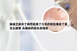 脑袋之前长了癣然后用了几天药现在爆皮了是怎么回事 头癣抹药后头皮爆皮