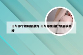 山东哪个银屑病最好 山东哪里治疗银屑病最好