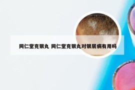 同仁堂克银丸 同仁堂克银丸对银屑病有用吗