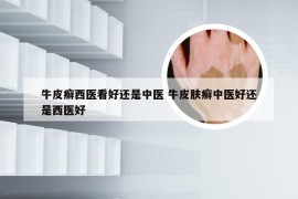 牛皮癣西医看好还是中医 牛皮肤癣中医好还是西医好