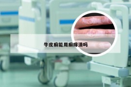 牛皮癣能用癣痒清吗