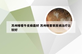 苏州哪看牛皮癣最好 苏州哪里银屑病治疗比较好