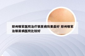 郑州哪家医院治疗银屑病效果最好 郑州哪家治银屑病医院比较好