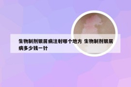 生物制剂银屑病注射哪个地方 生物制剂银屑病多少钱一针