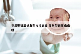 寻常型银屑病典型皮损表现 寻常型银屑病病程