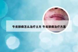 牛皮肤癣怎么治疗土方 牛皮肤癣治疗方案