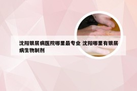 沈阳银屑病医院哪里最专业 沈阳哪里有银屑病生物制剂