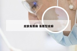 皮肤角质癣 角质型皮癣