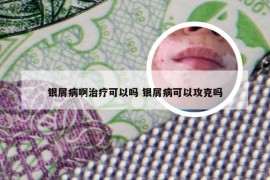 银屑病啊治疗可以吗 银屑病可以攻克吗