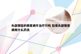 头部很轻的银屑病不治疗行吗 轻度头部银屑病用什么药洗