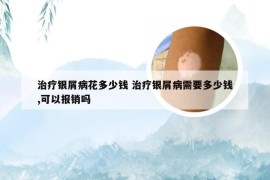 治疗银屑病花多少钱 治疗银屑病需要多少钱,可以报销吗