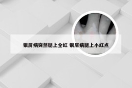 银屑病突然腿上全红 银屑病腿上小红点