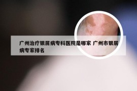 广州治疗银屑病专科医院是哪家 广州市银屑病专家排名