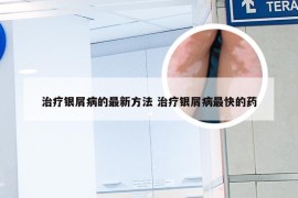 治疗银屑病的最新方法 治疗银屑病最快的药