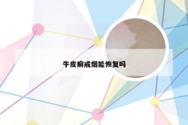牛皮癣戒烟能恢复吗