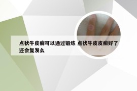 点状牛皮癣可以通过锻炼 点状牛皮皮癣好了还会复发么
