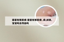 婆婆有银屑病 婆婆有银屑病 ,痒,掉屑,宝宝吗会传染吗