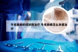 牛皮肤癣的症状和治疗 牛皮肤癣怎么快速治疗