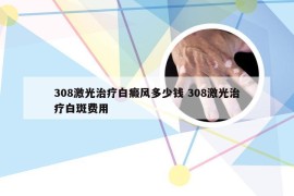 308激光治疗白癜风多少钱 308激光治疗白斑费用