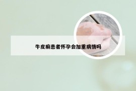 牛皮癣患者怀孕会加重病情吗
