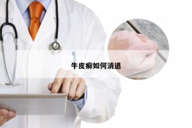 牛皮癣如何消退