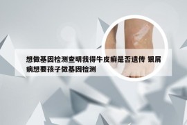 想做基因检测查明我得牛皮癣是否遗传 银屑病想要孩子做基因检测