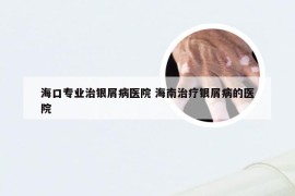 海口专业治银屑病医院 海南治疗银屑病的医院