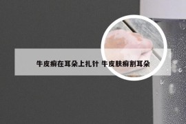 牛皮癣在耳朵上扎针 牛皮肤癣割耳朵