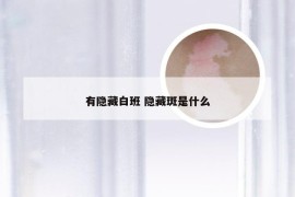 有隐藏白班 隐藏斑是什么