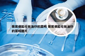 银屑病能吃蚝油炒的菜吗 银屑病能吃蚝油炒的菜吗图片