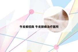 牛皮癣招商 牛皮肤癣治疗医院