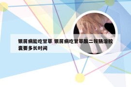 银屑病能吃甘草 银屑病吃甘草酸二铵肠溶胶囊要多长时间