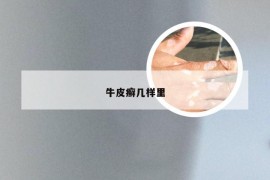 牛皮癣几样里