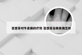 百想膏对牛皮癣的疗效 百想膏治银屑病怎样