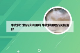 牛皮鲜只擦药膏有用吗 牛皮鲜用啥药洗能治好