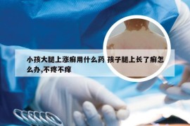 小孩大腿上涨癣用什么药 孩子腿上长了癣怎么办,不疼不痒