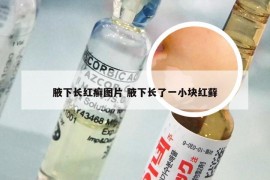 腋下长红癣图片 腋下长了一小块红藓