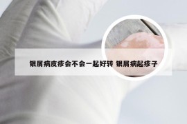 银屑病皮疹会不会一起好转 银屑病起疹子