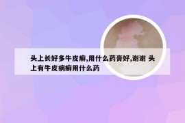 头上长好多牛皮癣,用什么药膏好,谢谢 头上有牛皮病癣用什么药