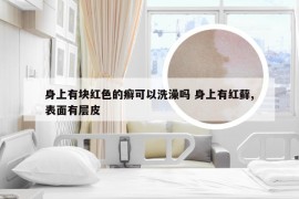 身上有块红色的癣可以洗澡吗 身上有红藓,表面有层皮