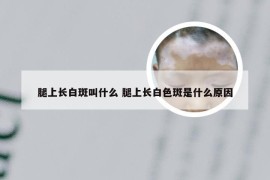 腿上长白斑叫什么 腿上长白色斑是什么原因