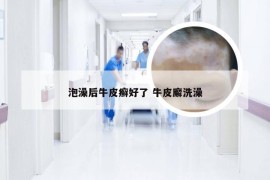 泡澡后牛皮癣好了 牛皮廨洗澡