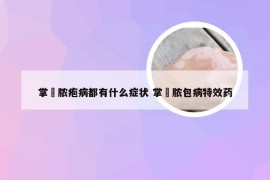 掌砋脓疱病都有什么症状 掌砋脓包病特效药
