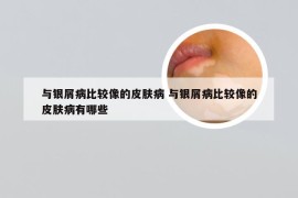 与银屑病比较像的皮肤病 与银屑病比较像的皮肤病有哪些