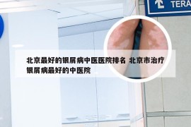北京最好的银屑病中医医院排名 北京市治疗银屑病最好的中医院