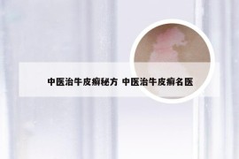 中医治牛皮癣秘方 中医治牛皮癣名医