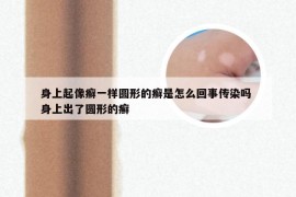 身上起像癣一样圆形的癣是怎么回事传染吗 身上出了圆形的癣
