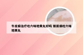 牛皮癣治疗吃六味地黄丸好吗 银屑病吃六味地黄丸