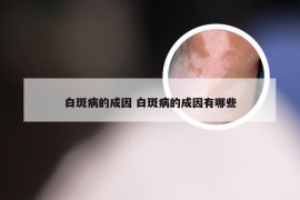 白斑病的成因 白斑病的成因有哪些